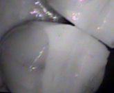 Same tooth with NEW filling.