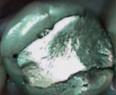 Old filling with tell tale cracks.