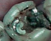 Decay is obvious once filling is removed.