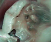 Decay is removed, leaving large hole in tooth.