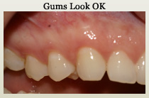 Gum disease examination
