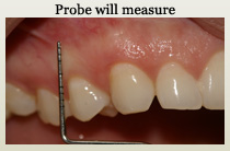 Gum disease examination
