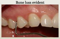 Gum disease examination